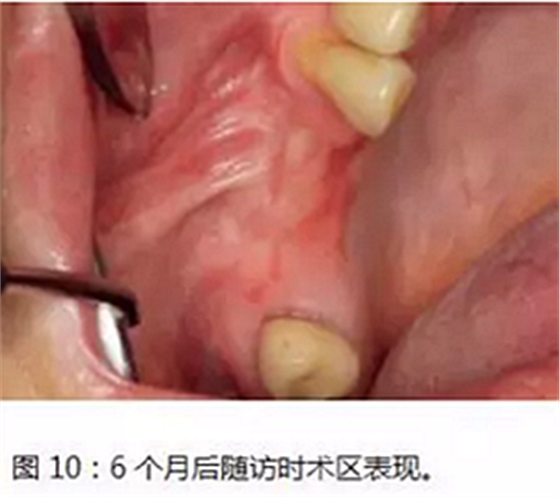 上頜竇瘺修補術——改良式旋轉帶蒂粘膜瓣修補術的應用