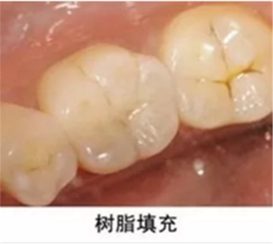 完全不懂，各種補牙材料，到底怎么選？