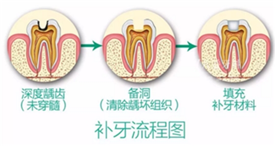 完全不懂，各種補牙材料，到底怎么選？