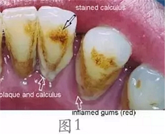 	 牙齦碰不得，一碰就出血。這是咋回事？