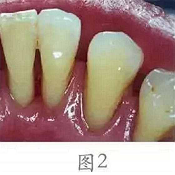 	 牙齦碰不得，一碰就出血。這是咋回事？