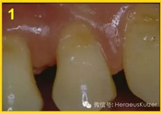 簡(jiǎn)單治療——格魯瑪脫敏劑的應(yīng)用