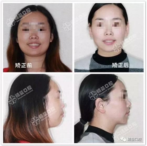 27歲嚴重齙牙，上下門牙牙根吸收嚴重，兩年矯正徹底蛻變，組建幸福家庭