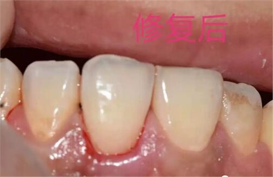 什么是牙齒楔缺？
