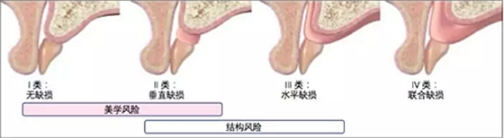 【文獻精讀】唇-齒-牙槽嵴分類：無牙頜上頜牙弓指南。診斷，風險評估及種植治療指征