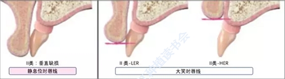 【文獻精讀】唇-齒-牙槽嵴分類：無牙頜上頜牙弓指南。診斷，風險評估及種植治療指征