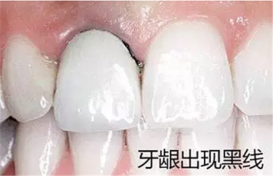 	烤瓷牙出現問題【不要猶豫】盡快去醫院拆除！