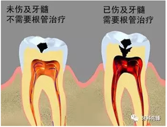補牙不做冠，療效少一半！根管治療后牙齒已經不疼了，為什么還要戴牙冠呢？