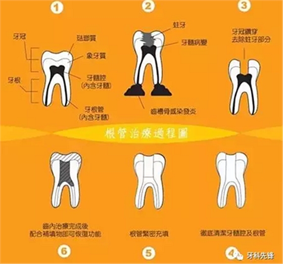 補牙不做冠，療效少一半！根管治療后牙齒已經不疼了，為什么還要戴牙冠呢？