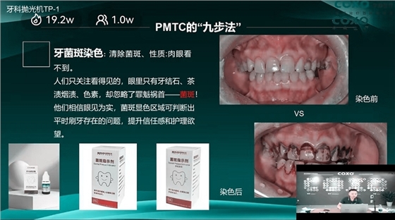 牙菌斑染色 牙菌斑染色