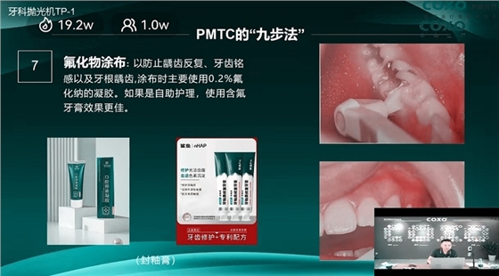氟化物涂布 氟化物涂布
