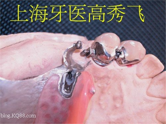 圖解后牙精密附著體修復2例（原創）
