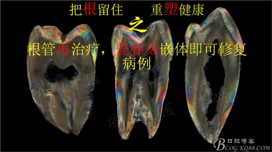 根管再治療，高嵌體即可修復(fù)（濟(jì)南牙醫(yī)~ 李強(qiáng)）