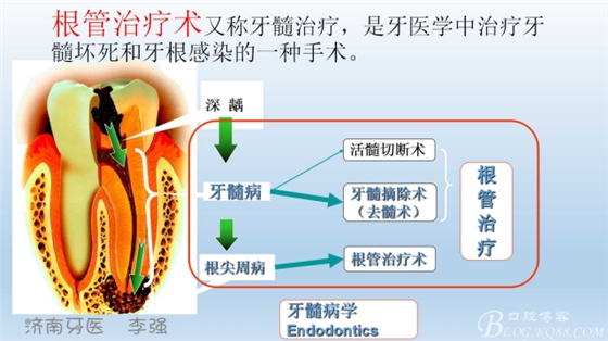 根管再治療，高嵌體即可修復(fù)（濟(jì)南牙醫(yī)~ 李強(qiáng)）