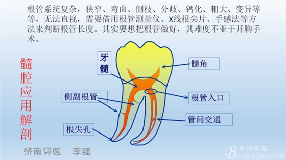 根管再治療，高嵌體即可修復(fù)（濟(jì)南牙醫(yī)~ 李強(qiáng)）