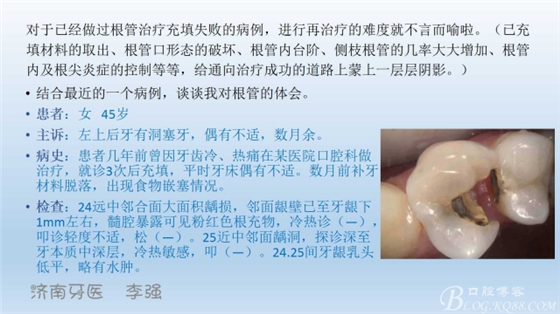 根管再治療，高嵌體即可修復(fù)（濟(jì)南牙醫(yī)~ 李強(qiáng)）