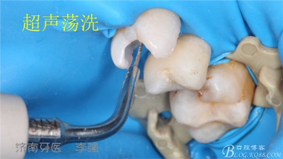 根管再治療，高嵌體即可修復(fù)（濟(jì)南牙醫(yī)~ 李強(qiáng)）