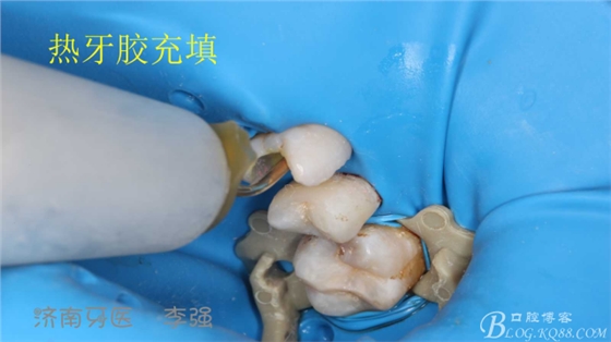 根管再治療，高嵌體即可修復(fù)（濟(jì)南牙醫(yī)~ 李強(qiáng)）