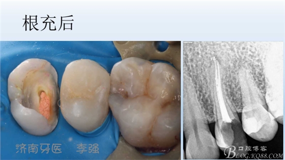 根管再治療，高嵌體即可修復(fù)（濟(jì)南牙醫(yī)~ 李強(qiáng)）