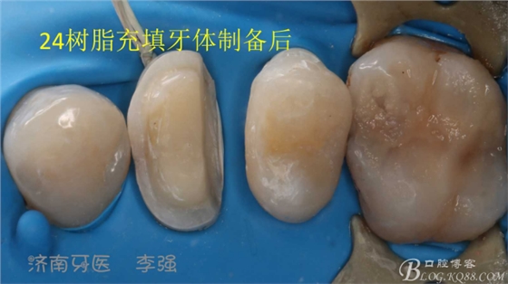 根管再治療，高嵌體即可修復(fù)（濟(jì)南牙醫(yī)~ 李強(qiáng)）