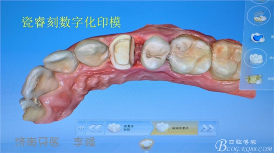 根管再治療，高嵌體即可修復(fù)（濟(jì)南牙醫(yī)~ 李強(qiáng)）