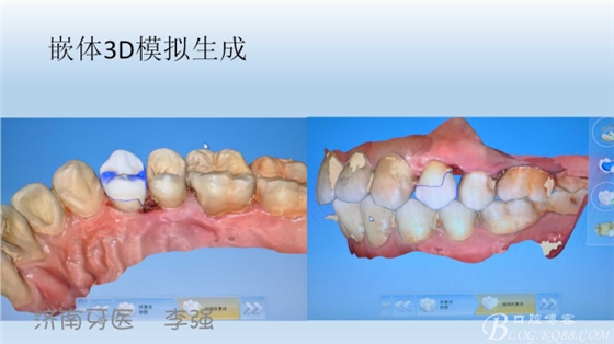 根管再治療，高嵌體即可修復(fù)（濟(jì)南牙醫(yī)~ 李強(qiáng)）