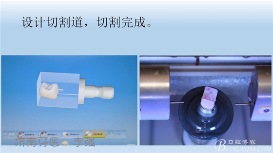根管再治療，高嵌體即可修復(fù)（濟(jì)南牙醫(yī)~ 李強(qiáng)）