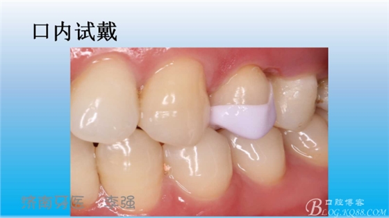 根管再治療，高嵌體即可修復(fù)（濟(jì)南牙醫(yī)~ 李強(qiáng)）
