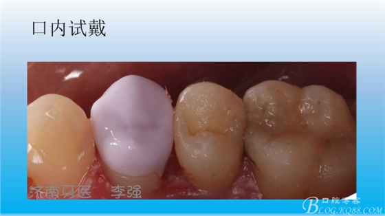 根管再治療，高嵌體即可修復(fù)（濟(jì)南牙醫(yī)~ 李強(qiáng)）