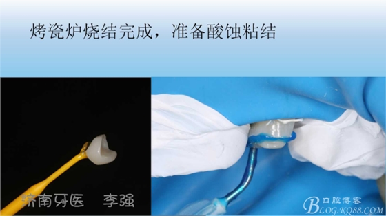 根管再治療，高嵌體即可修復(fù)（濟(jì)南牙醫(yī)~ 李強(qiáng)）