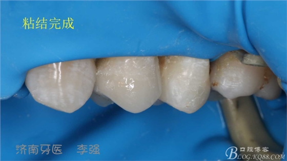 根管再治療，高嵌體即可修復(fù)（濟(jì)南牙醫(yī)~ 李強(qiáng)）