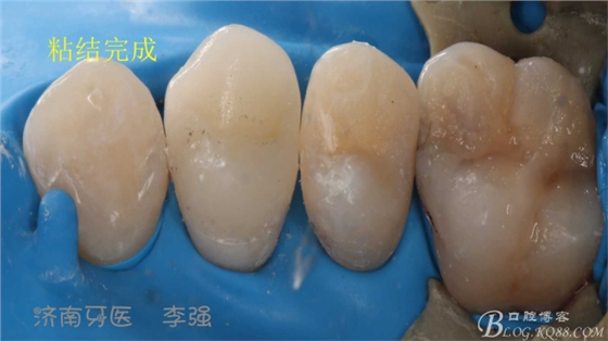 根管再治療，高嵌體即可修復(fù)（濟(jì)南牙醫(yī)~ 李強(qiáng)）