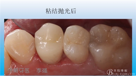 根管再治療，高嵌體即可修復(fù)（濟(jì)南牙醫(yī)~ 李強(qiáng)）