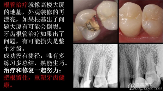 根管再治療，高嵌體即可修復(fù)（濟(jì)南牙醫(yī)~ 李強(qiáng)）