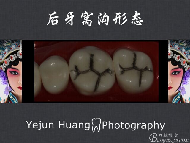 黃葉君：淺談口腔固定修復流程]第四期：后牙的預備流程