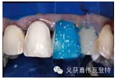 義獲嘉貼面粘接的操作步驟！