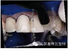 義獲嘉貼面粘接的操作步驟！