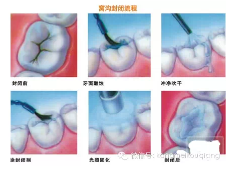 口腔窩溝封閉，就如同給牙齒穿上了一層保護衣，使牙齒免受食物侵蝕。原理：窩溝封閉后，窩溝內原有的細菌斷。
