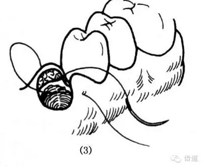 牙醫基本技能：口內縫合術（文字、示意圖及視頻）