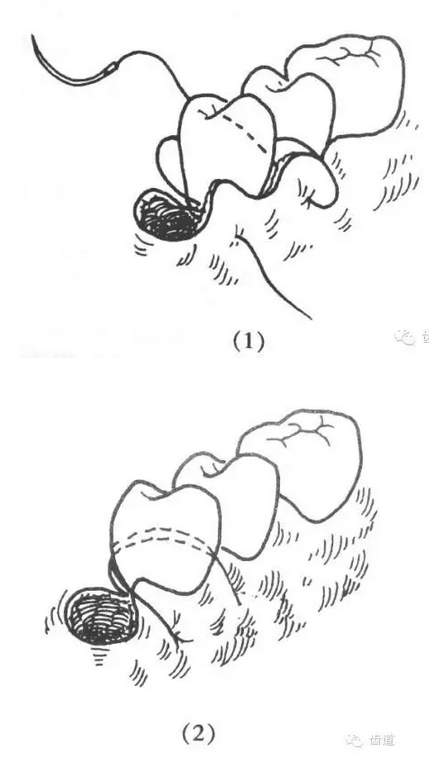 牙醫基本技能：口內縫合術（文字、示意圖及視頻）