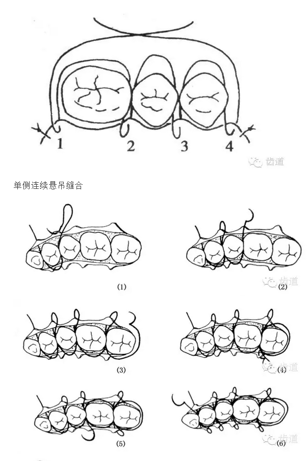 牙醫基本技能：口內縫合術（文字、示意圖及視頻）
