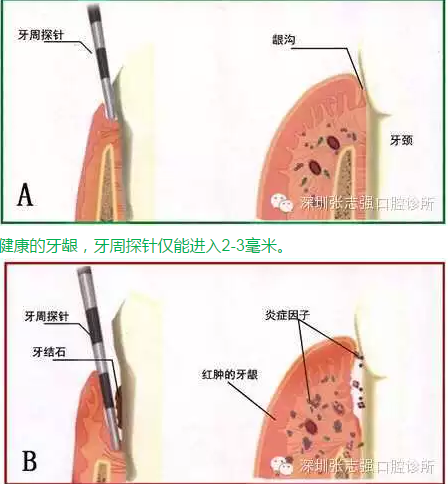 刷牙出血，牙齦紅腫，并非缺乏維生素