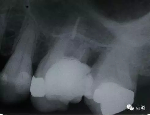 根管治療的并發癥及處理