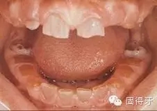 只知道蟲牙？快來看看那些你見都沒見過的牙病！ 
