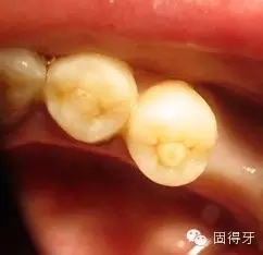 只知道蟲牙？快來看看那些你見都沒見過的牙病！ 