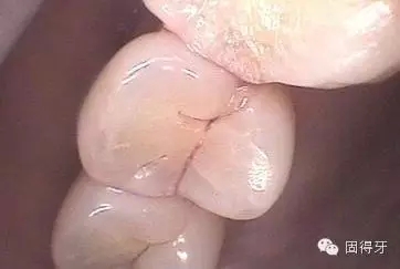 只知道蟲牙？快來看看那些你見都沒見過的牙病！ 