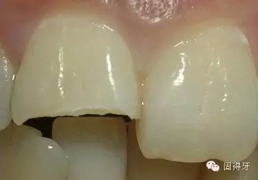只知道蟲牙？快來看看那些你見都沒見過的牙病！ 