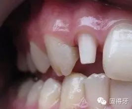 只知道蟲牙？快來看看那些你見都沒見過的牙病！ 