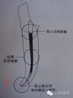 關(guān)于根管治療過程中的“激惹”現(xiàn)象