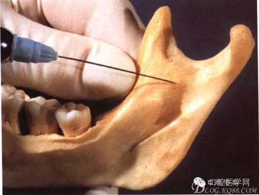即使是老手也會(huì)失手的麻醉----下牙槽、舌、頰一次阻滯麻醉